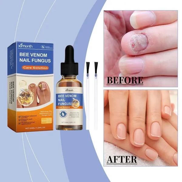 Nail Fungal Treatment Essential Oil Foot Toe Nail Fungus Removal Serum 7 Days Repair Onychomycosi Anti Infection Care Products