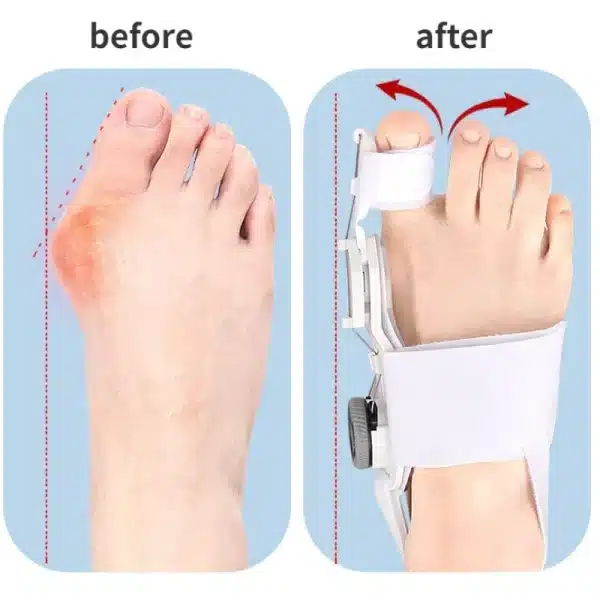 Bunion Corrector Unisex Foot Hallux Valgus Braces Rotatable Toe Separator Straightener Adjustable Pedicure Finger Toe Corrector - Image 2