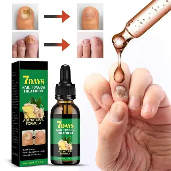 Nail Fungal Treatment Device 7 Days Repair Oil Foot Toe Essence Anti Infection Paronychia Ginger Onychomycosis Gel Care Products - Image 2