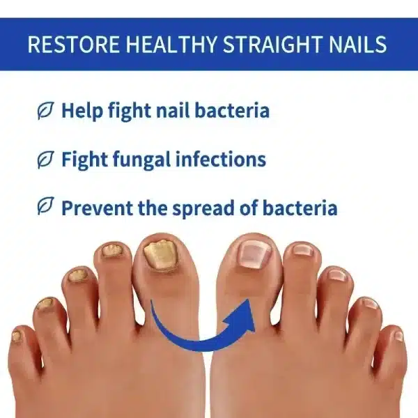 Fungal Nail Treatment Removal Oil Foot Fungus Repair Essence Toe Fungus Removal Gel Anti Infection Onychomycosis Essenice - Image 4