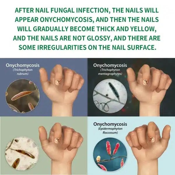 Nail Fungal Treatment Device 7 Days Repair Oil Foot Toe Essence Anti Infection Paronychia Ginger Onychomycosis Gel Care Products - Image 6