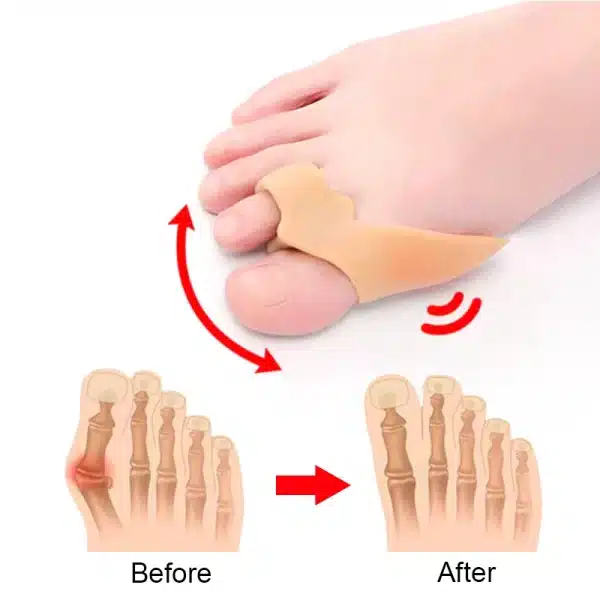 Protect Toe Separator Bunion Hallux Valgus Foot Care Tool G045*20 - Image 5