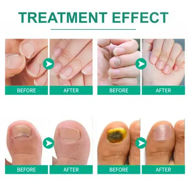 Extra Strong Nail Fungus Treatment Serum Essence oil Feet Nails Repair Care Essence Cream Anti Infection Toe Fungal Removal - Image 3