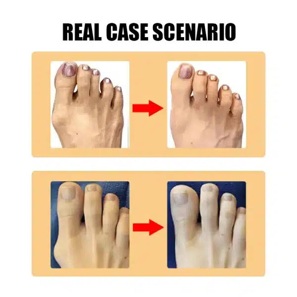 Protect Toe Separator Bunion Hallux Valgus Foot Care Tool G045*20 - Image 2