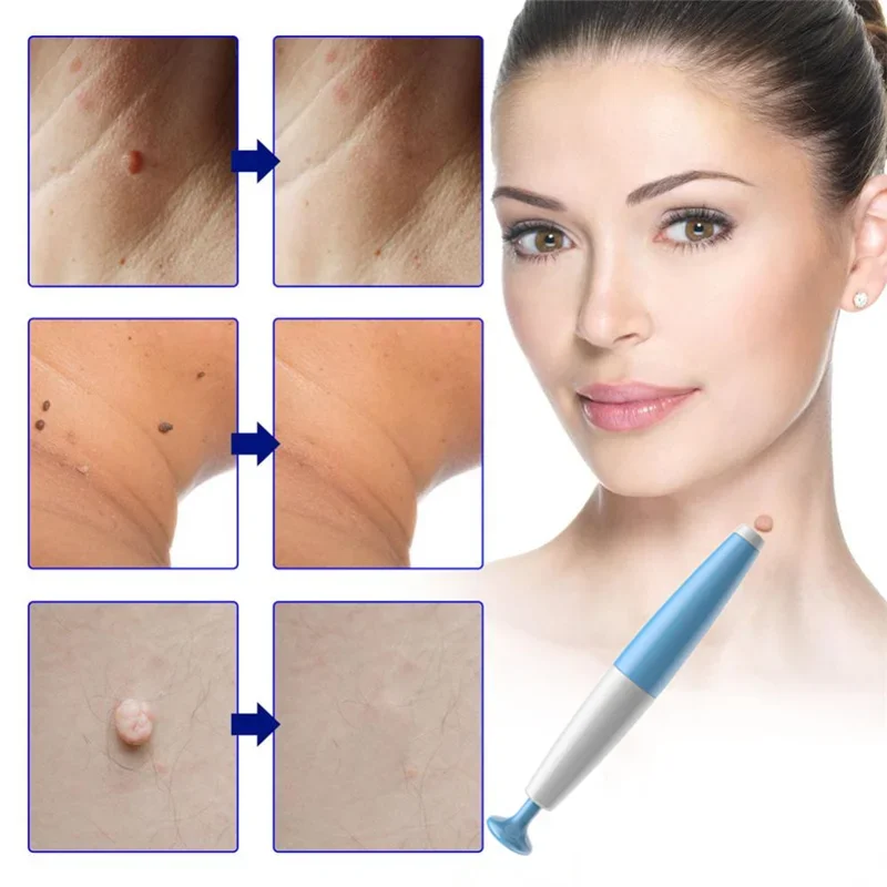 1Set Skin Tag Removal Skin Cleansing Kit For 2-4mm Skin Tag Treatment Removes In Skin Wart Mole Skin Tag Removal Tool Face Care